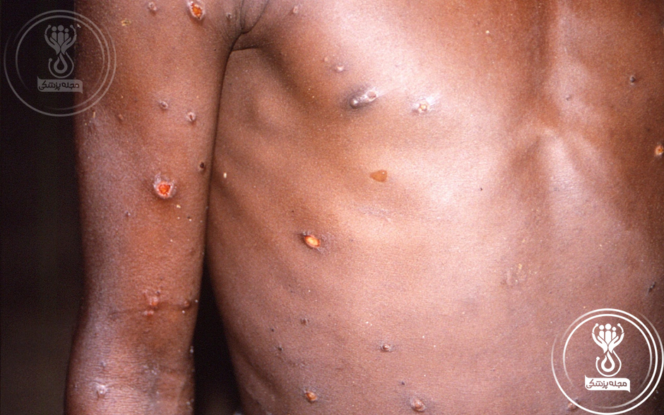 نشانه‌های بیماری آبله میمون روی پوست
